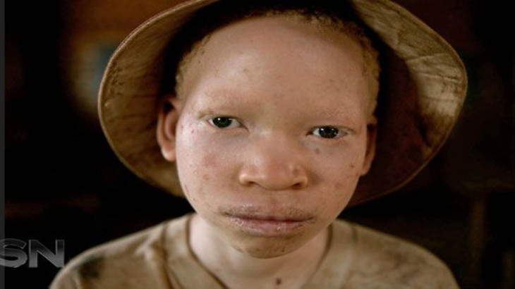 Di Negara ini, Orang Albino Diasingkan dan Diintimidasi 