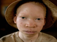 Di Negara ini, Orang Albino Diasingkan dan Diintimidasi 