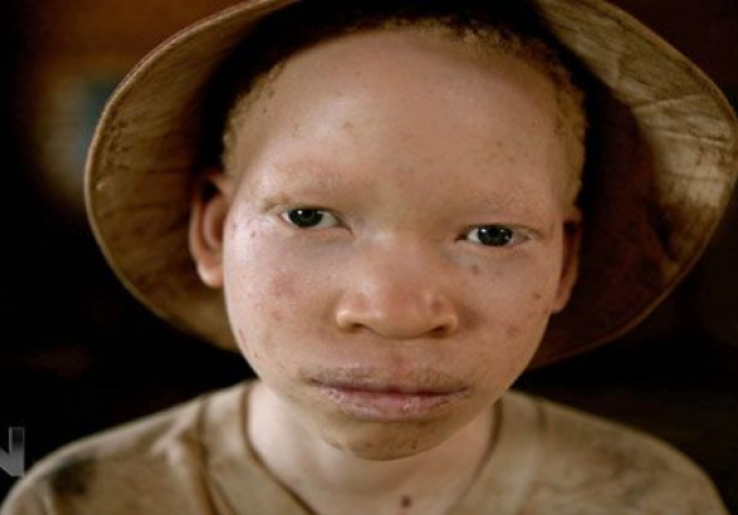 Di Negara ini, Orang Albino Diasingkan dan Diintimidasi 
