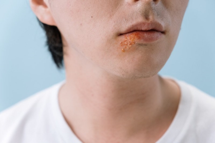 ilustrasi penderita herpes (Foto: Pexel)	