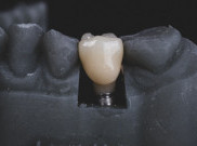 Atasi Gigi Ngilu dengan Cara Sederhana Ini