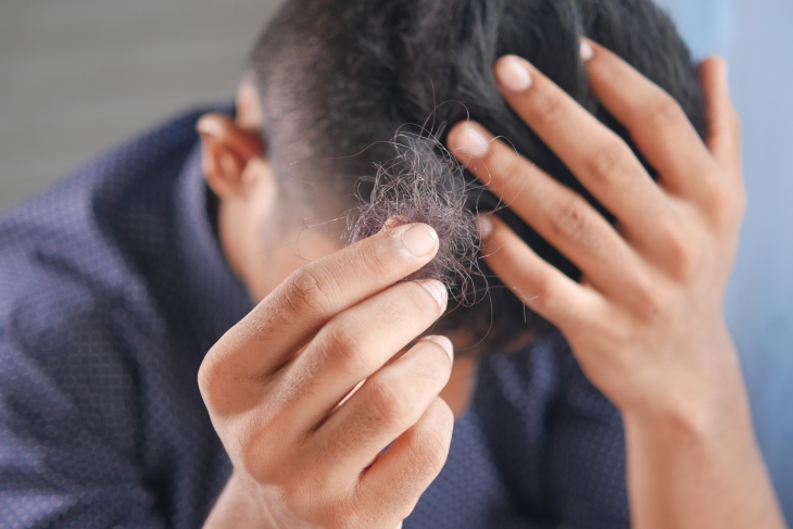 Kenali Psoriasis Kulit Kepala dan Cara Menanganinya