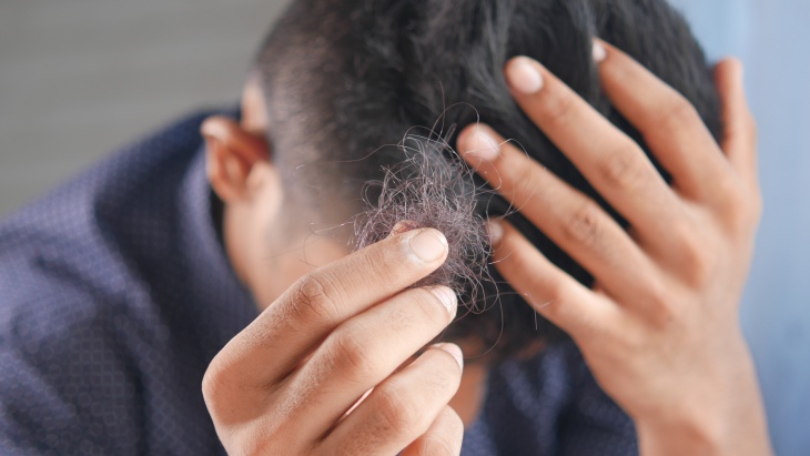Mengenal Proses Transplantasi Rambut 