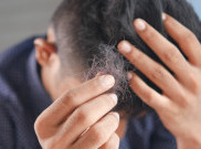 Mengenal Proses Transplantasi Rambut 
