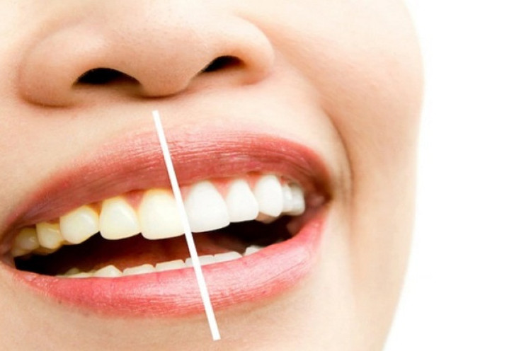 Tahu Lengkap tentang Pemutihan Gigi