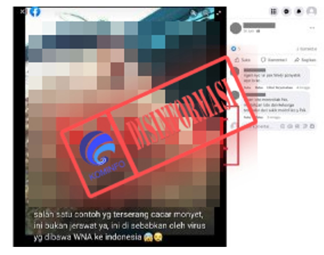 [HOAKS atau FAKTA]: Cacar Monyet Masuk Indonesia Dibawa Seorang WNA