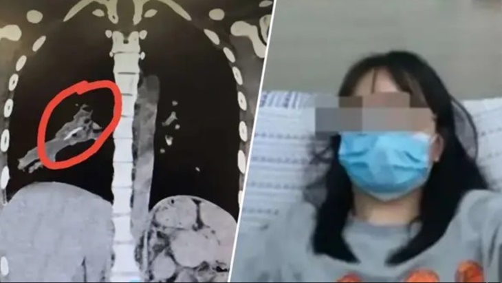 Gara-gara Tulang Ayam, Perempuan ini Batuk-Batuk Selama 14 Tahun