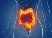 Waspadai Komplikasi dan Kematian Akibat Peradangan Usus Kronis