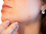 Solusi Atasi Skindemik, Masalah Kulit karena Pakai Masker Seharian