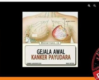 [HOAKS atau FAKTA]: Pakai Bra Tak Dicuci Sebabkan Kanker Payudara