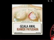 [HOAKS atau FAKTA]: Pakai Bra Tak Dicuci Sebabkan Kanker Payudara