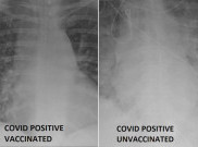 Menyeramkan! Intip Perbedaan Paru-Paru Pasien COVID-19 yang Belum dan Sudah Vaksin