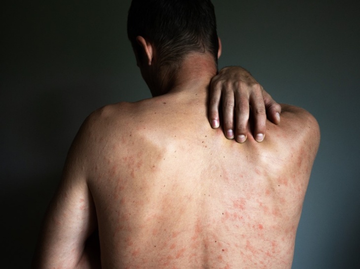 Mengenal Virus Cacar Monyet yang sedang Berjangkit di Inggris