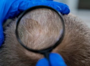 Mikropigmentasi Kulit Kepala dapat Bantu Atasi Penipisan Rambut