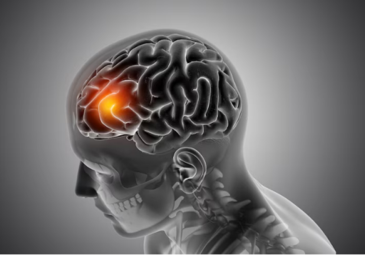 Apa Itu Brain Rot? Penyebab, Dampak, dan Cara Mengatasinya