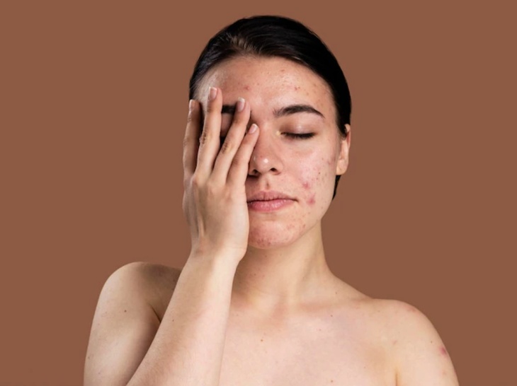 Cara Gunakan Riasan Wajah untuk Orang dengan Psoriasis