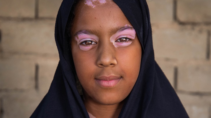 Pengobatan Autoimun Vitiligo yang Aman untuk Anak-Anak