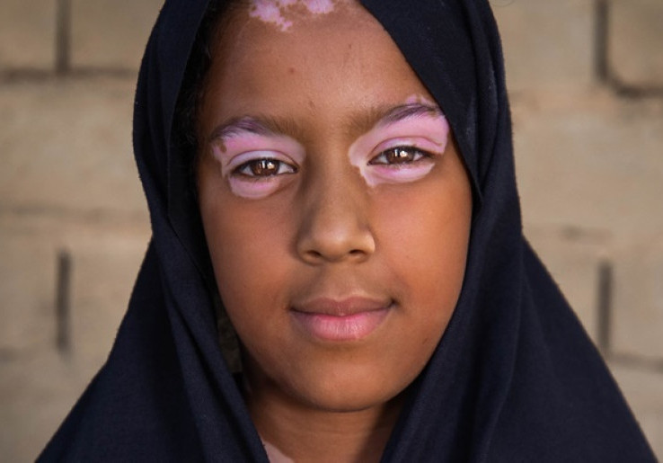 Pengobatan Autoimun Vitiligo yang Aman untuk Anak-Anak