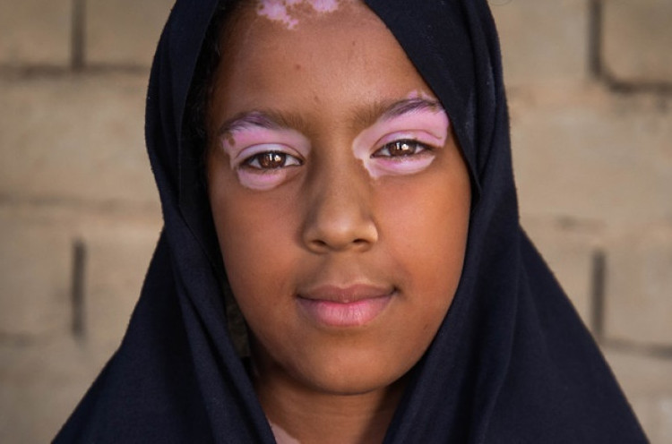 Pengobatan Autoimun Vitiligo yang Aman untuk Anak-Anak