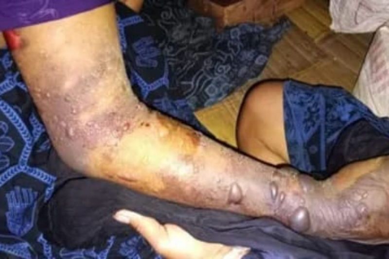 7 Warga Badui Tewas Digigit Ular Berbisa, Kelangkaan Serum ABU di Puskesmas Jadi Sorotan