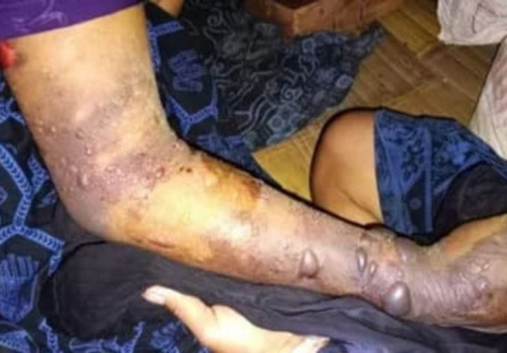 7 Warga Badui Tewas Digigit Ular Berbisa, Kelangkaan Serum ABU di Puskesmas Jadi Sorotan