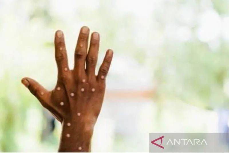 Inggris Laporkan Strain Baru Mpox
