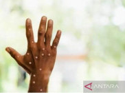Inggris Laporkan Strain Baru Mpox