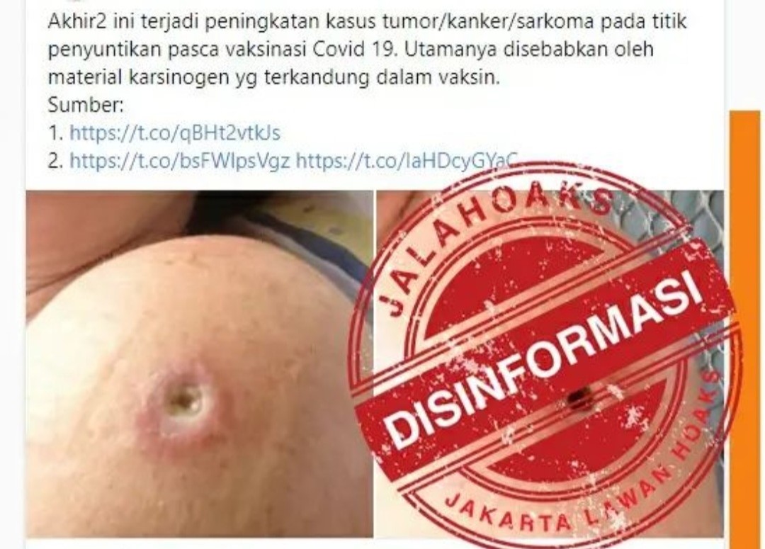 [HOAKS atau FAKTA]: Titik Suntikan Vaksin Sebabkan Tumor