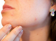 Jangan Facial Wajah yang Berjerawat