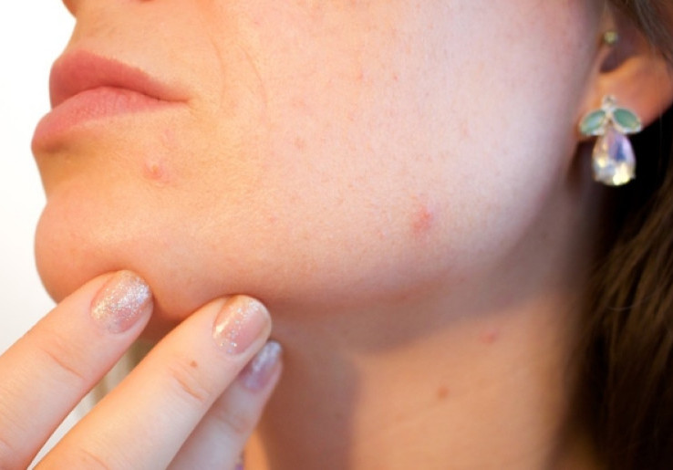 Jangan Facial Wajah yang Berjerawat