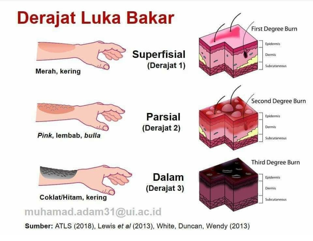 Tepat Tangani Luka Bakar Sesuai Tingkatannya Merahputih 0745