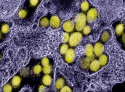 Mengenal Lebih Jauh Kawasaki Disease