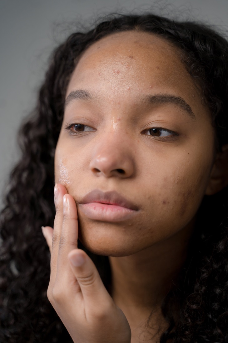 Shea butter juga dapat meredakan iritasi dan bekas jerawat. (Foto: Pexels/Ron Lach)