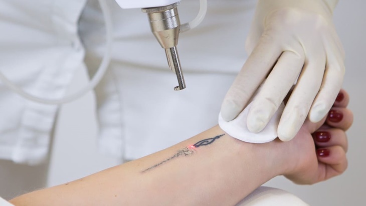 Hilangkan Tato Pakai Laser, Aman enggak Sih?