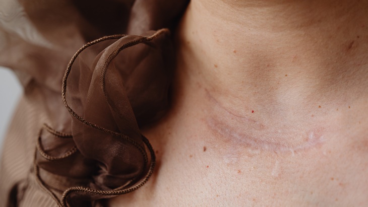 Keloid Bisa Hilang