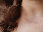 Keloid Bisa Hilang 
