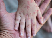 CDC Afrika Sebut Korban Jiwa Mpox Lampaui 1.100