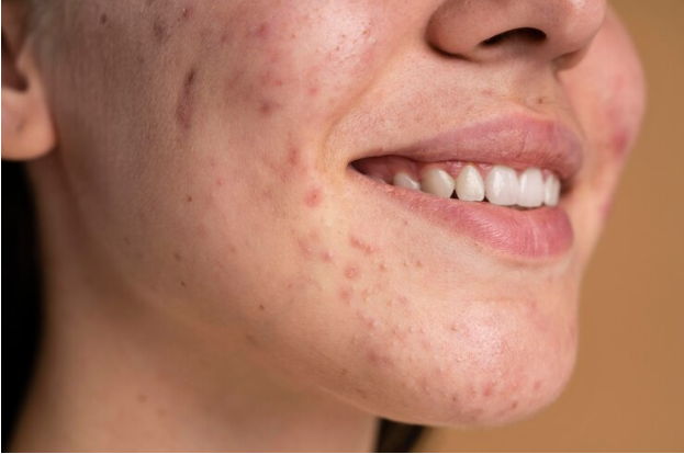 Apa Itu Herpes? Jenis, Gejala, dan Penyebabnya