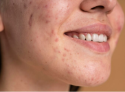 Apa Itu Herpes? Jenis, Gejala, dan Penyebabnya