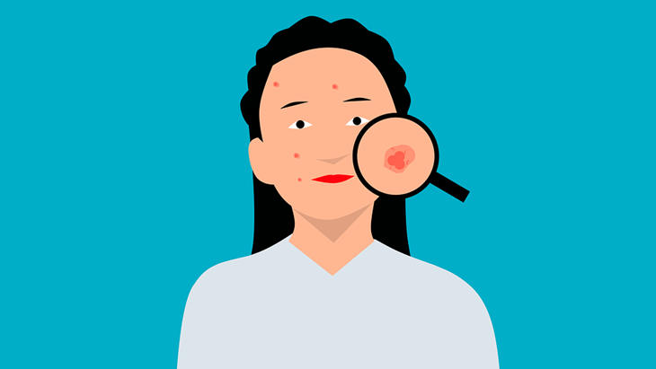 Tips Mengatasi Jerawat 'Fungal'