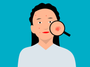 Tips Mengatasi Jerawat 'Fungal'