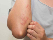 Sering Dijumpai, 5 Jenis Penyakit Kulit Ini Ternyata Menular