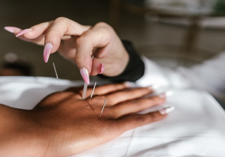 Kurangi Nyeri Masa Menopause dengan Akupunktur