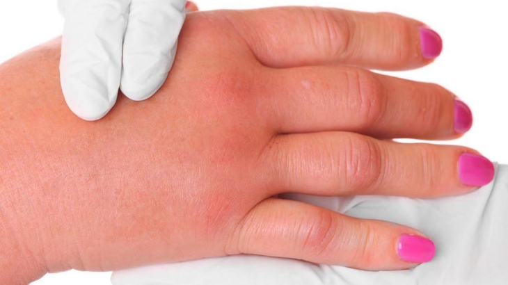 Mengenal Sindrom Edema Idiopatik