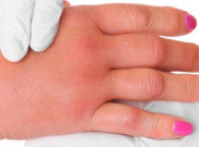 Mengenal Sindrom Edema Idiopatik