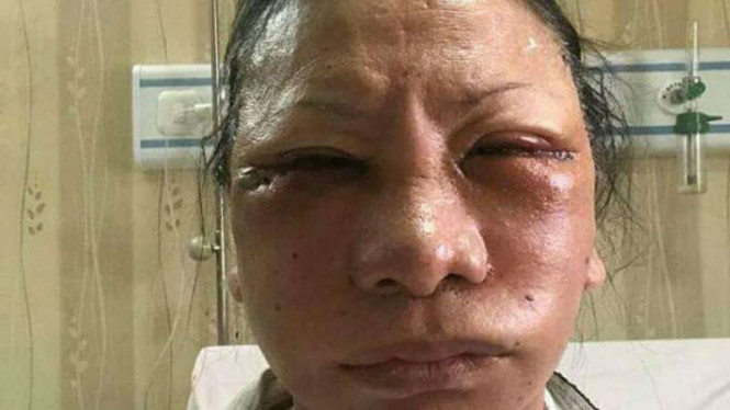 Ratna Sarumpaet usai jalani operasi plastik