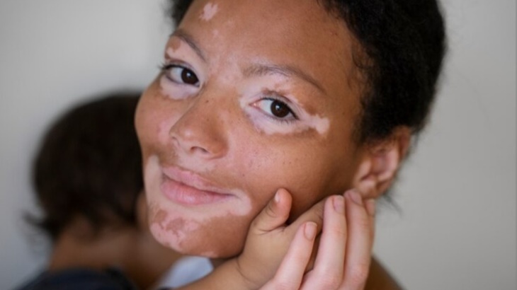 Krim yang dapat Kembalikan Pigmentasi Kulit Penderita Vitiligo