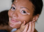 Krim yang dapat Kembalikan Pigmentasi Kulit Penderita Vitiligo