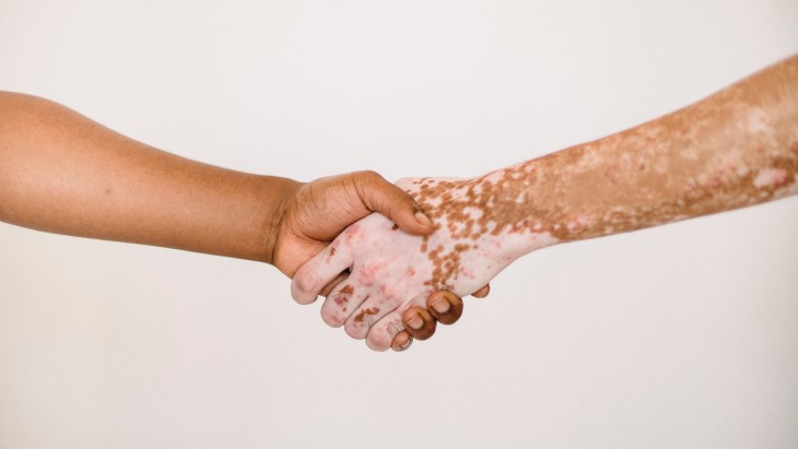 Vitiligo, Ketika Kulit Kehilangan Warna