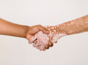 Vitiligo, Ketika Kulit Kehilangan Warna